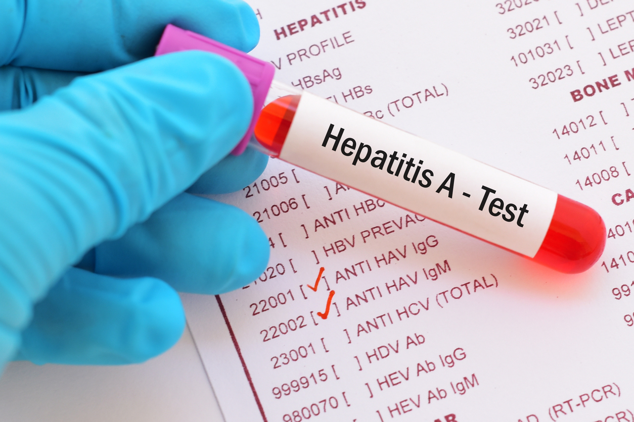 Image result for hepatitis a